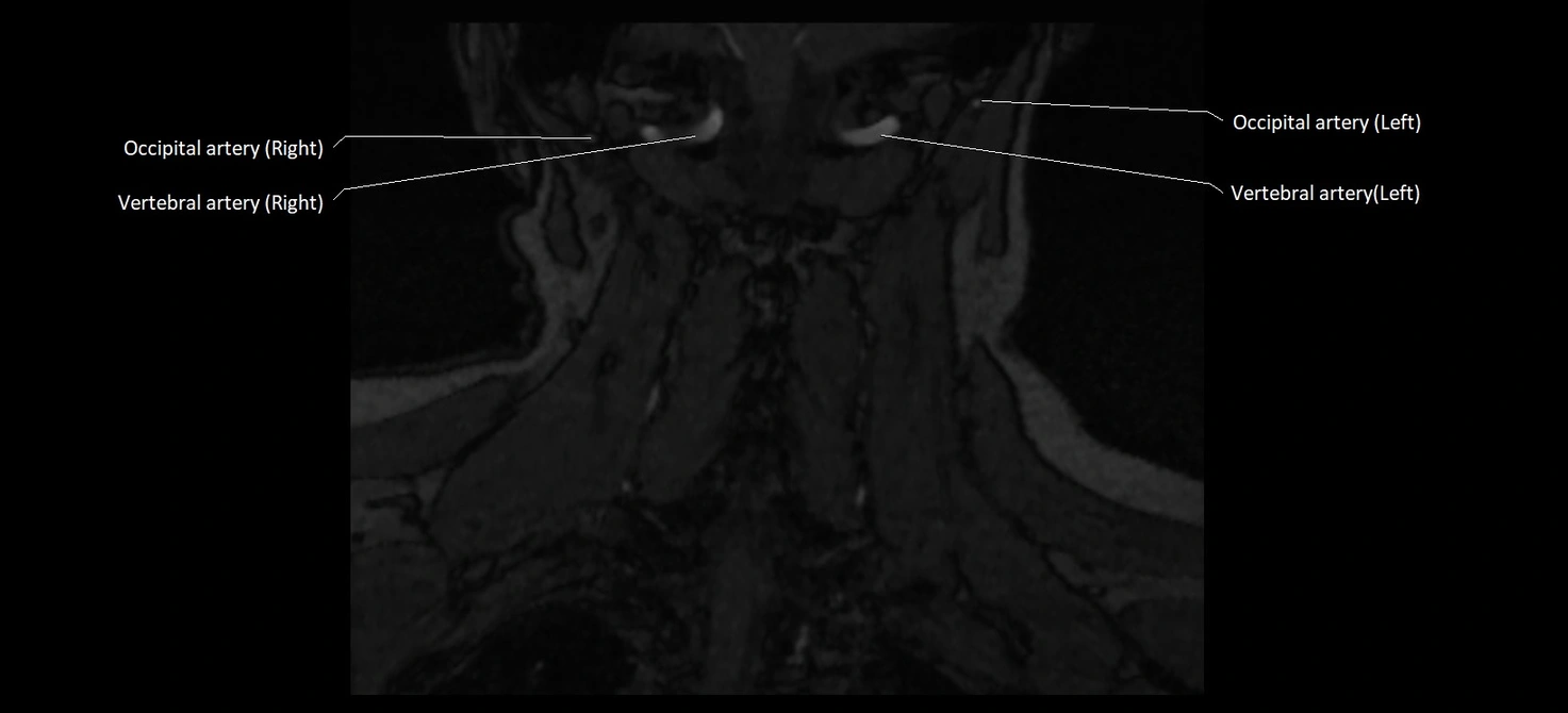 MRA carotid artery anatomy cross sectional 3T coronal image 17.webp